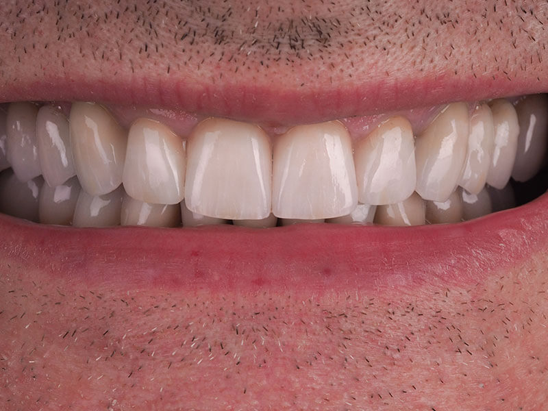 Korony pełnoceramiczne wykonane w Exacto Stomatologia podczas metamorfozy uśmiechu