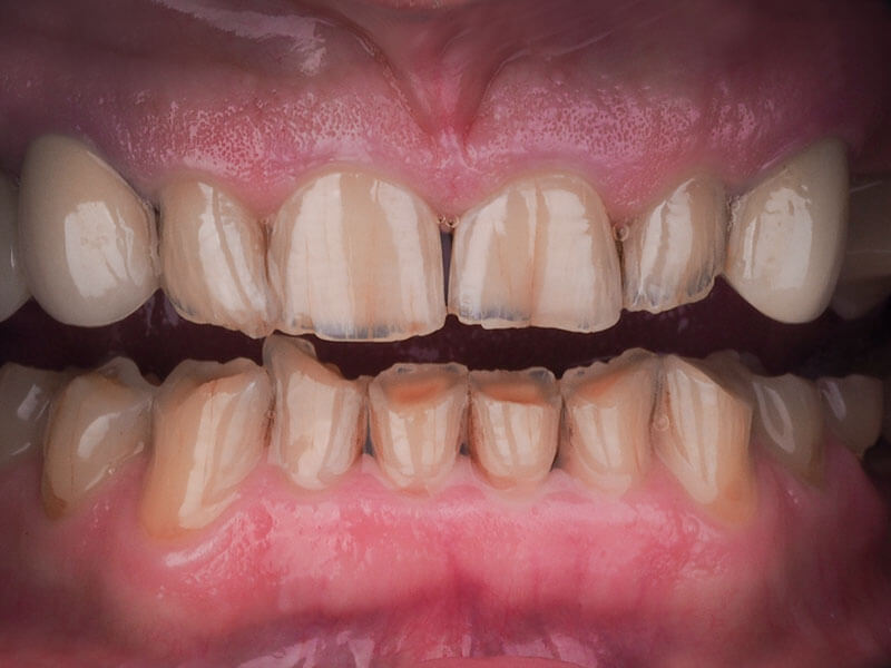 Starte zęby u mężczyzny w podeszłym wieku