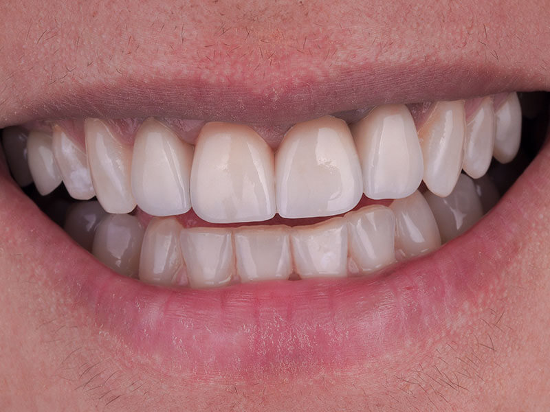 Po metamorfozie uśmiechu podczas której wykonano10 koron pełnoceramicznych wykonanych w Exacto Stomatologia.