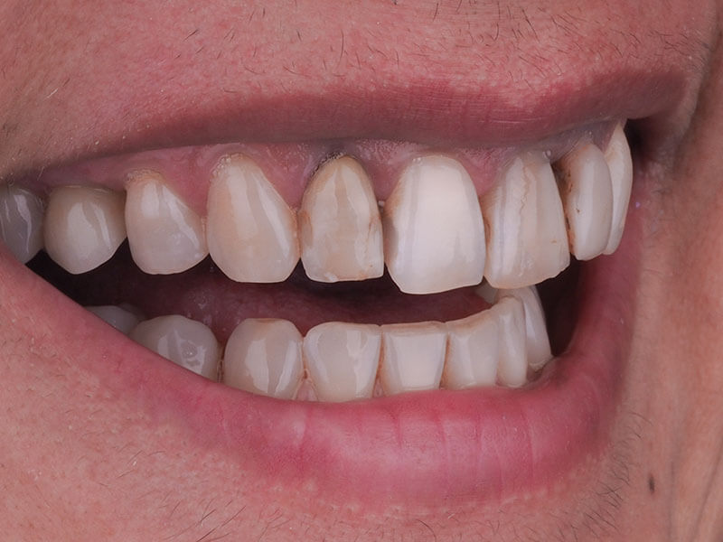 Uśmiech kobiety przed metamorfozą w Exacto Stomatologia