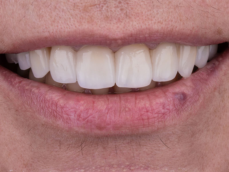 Uśmiech po wykonaniu koron Lava w klinice Exacto Stomatologia