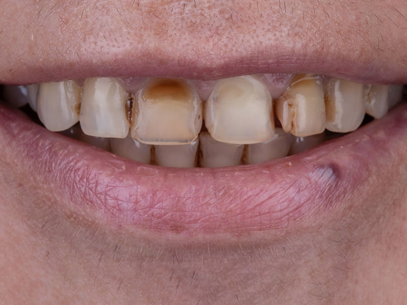 Uśmiech przed metamorfozą i wykonaniem licówek w Exacto Stomatologia