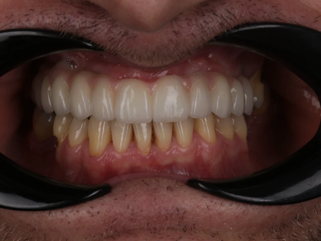 Praca na implantach All on eX