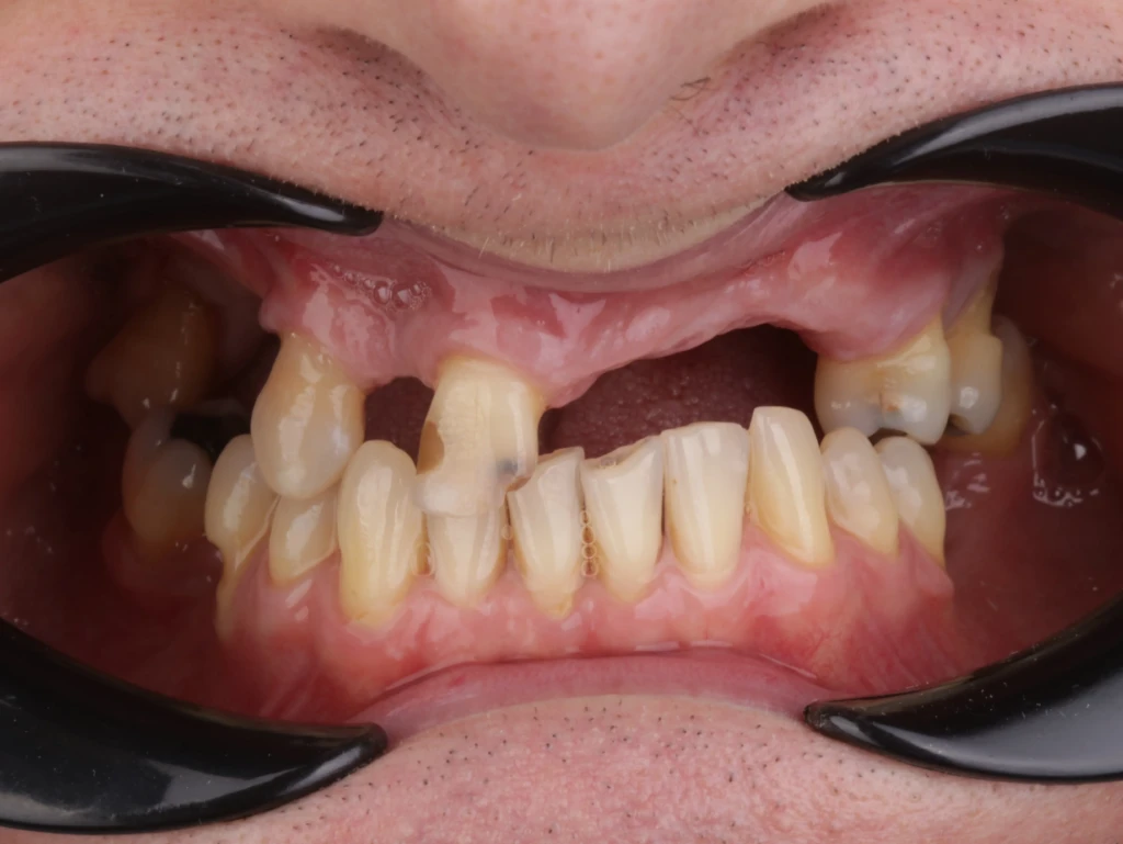 Praca na implantach All on eX