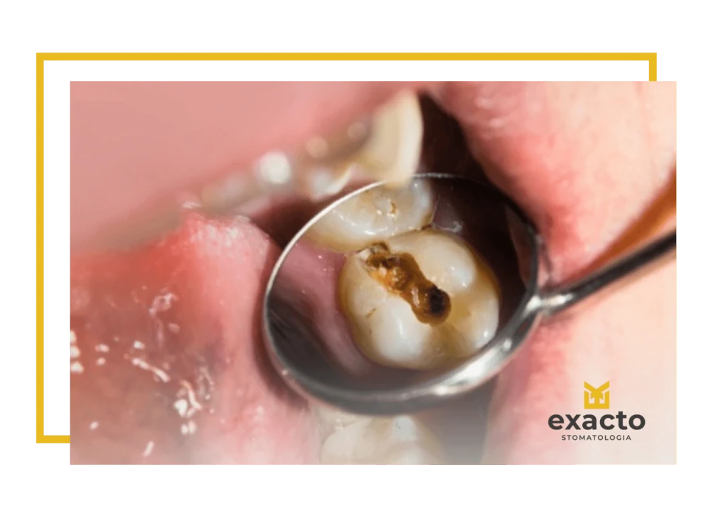 ząb do leczenia kanałowego