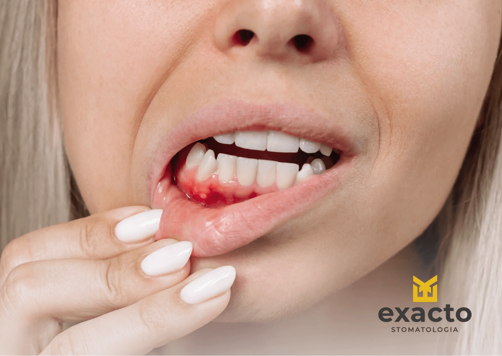 Stan zapalny dziąseł — jak sobie z nim radzić?