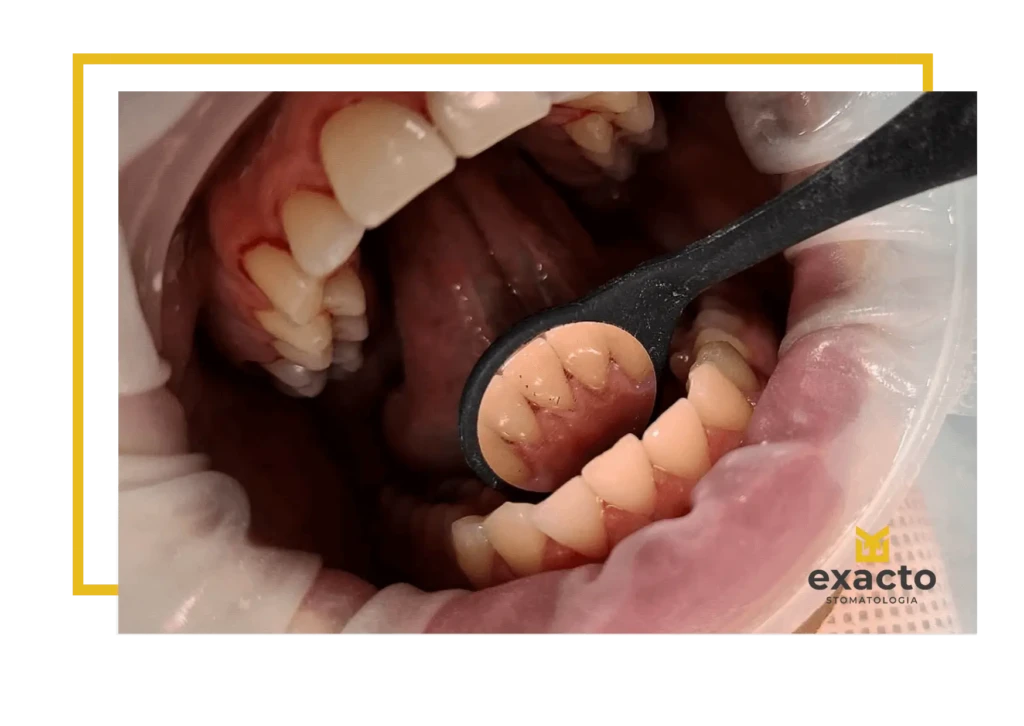 Higienizacja zębów przed i po