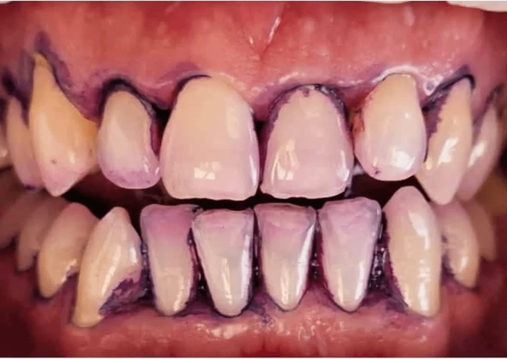 higienizacja zębów przed i po