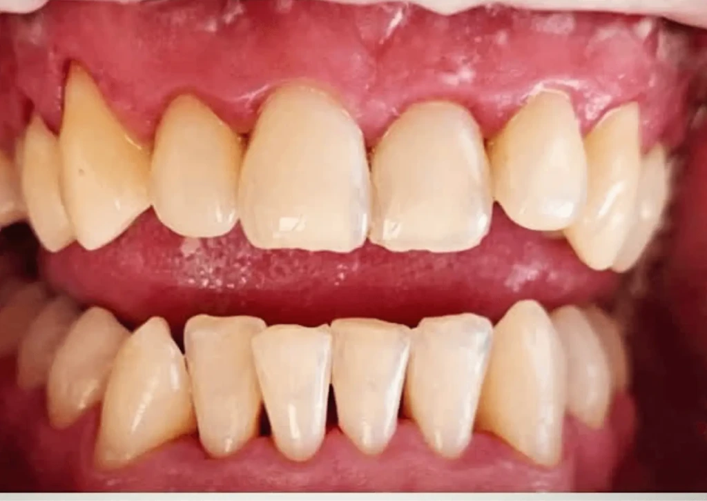 higienizacja zębów przed i po