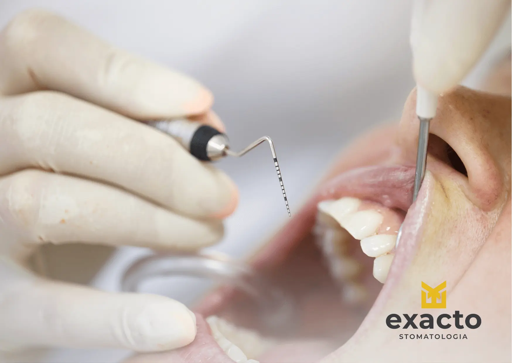 Paradontoza — objawy, przyczyny i sposoby leczenia