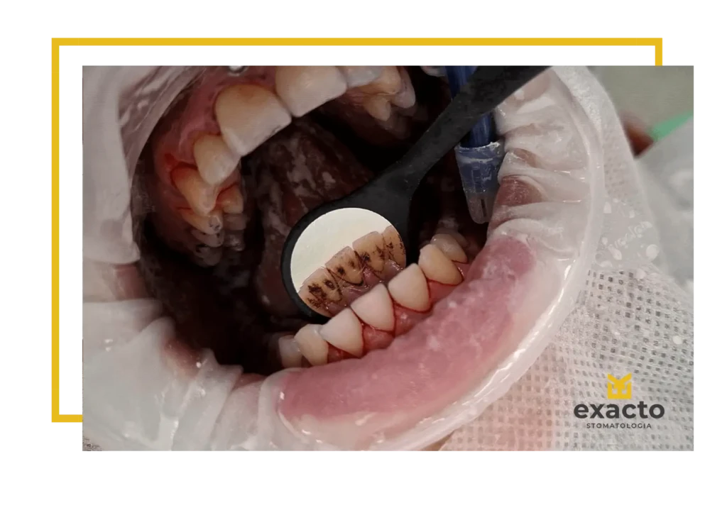 Higienizacja zębów przed i po