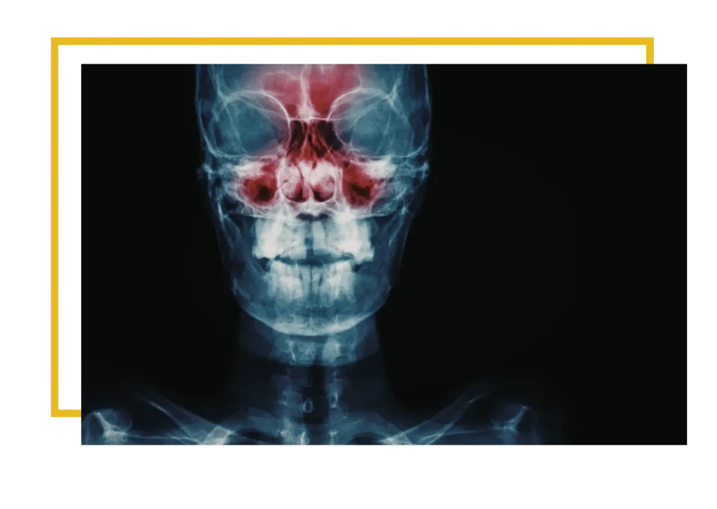 podnoszenie zatoki szczękowej, wskazania do zabiegu