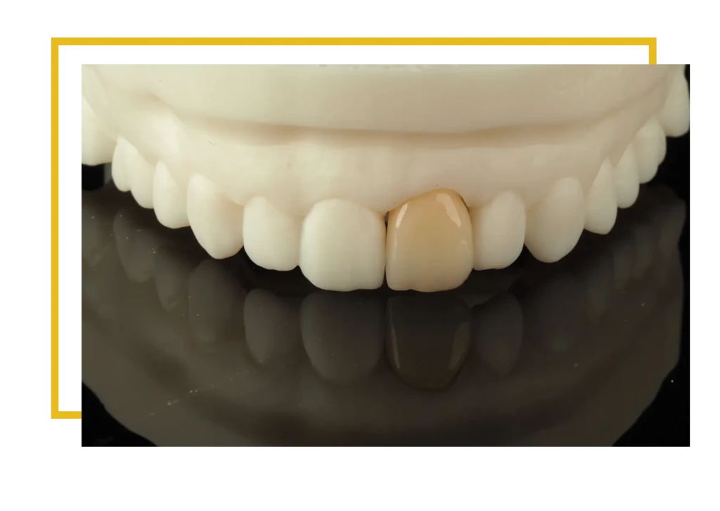 licówki porcelanowe