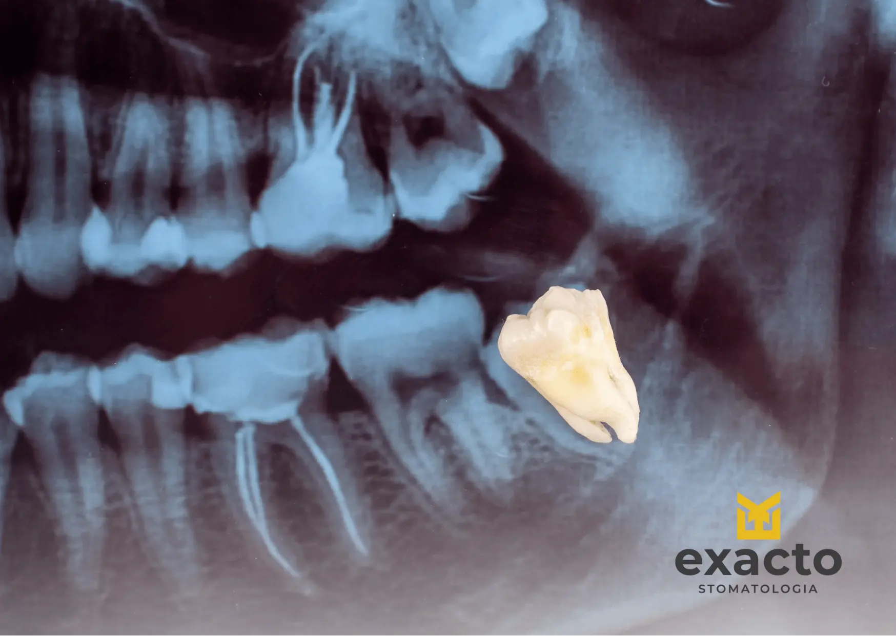 Zatrzymane ósemki są dosyć powszechnym problemem, do którego dochodzi w momencie, gdy ząb pozostaje w kości lub pod dziąsłem, zamiast pojawić się w łuku zębowym.