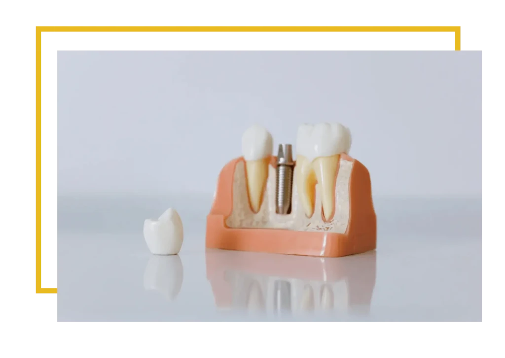 Natychmiastowa implantacja poznań