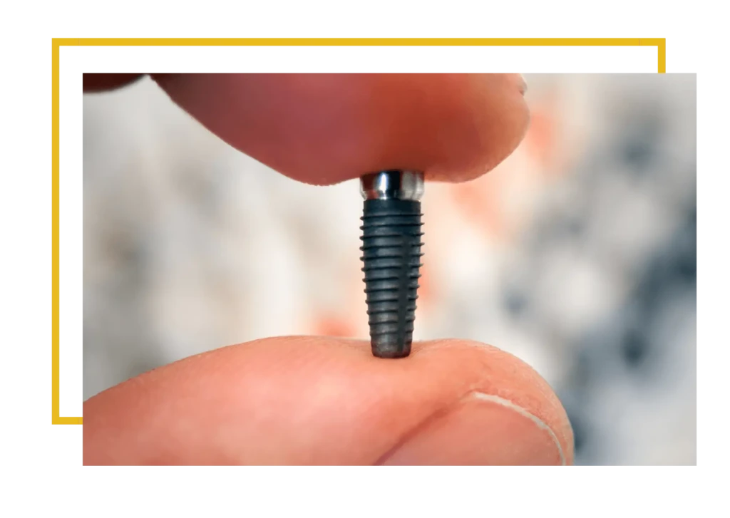 Implanty zębowe to niewielkie, tytanowe elementy, przypominające śruby, które zastępują korzeń naturalnego zęba.