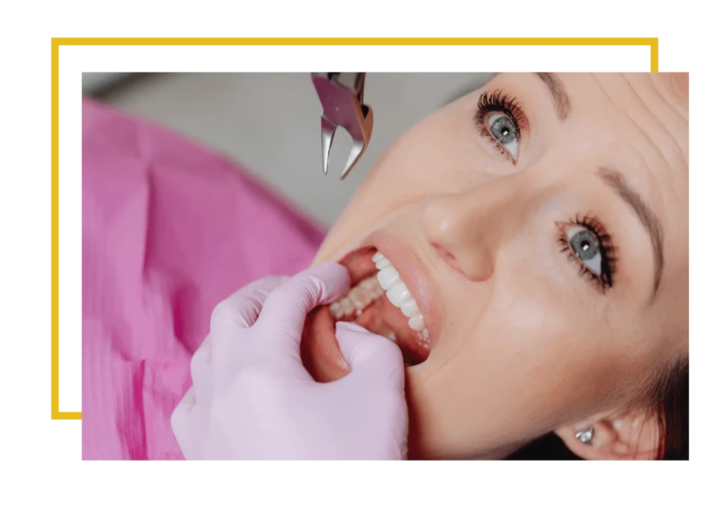 Decyzja o usunięciu zatrzymanej ósemki zależy od wielu czynników i zawsze powinna być poprzedzona dokładną diagnostyką. Każdy przypadek jest inny, dlatego chirurg decyzję podejmuje wspólnie z Pacjentem po badaniu klinicznym i analizie RTG. Wskazaniem do ekstrakcji są przede wszystkim nawracające stany zapalne, ból, próchnica, uszkodzenie sąsiednich zębów oraz brak miejsca w łuku zębowym.