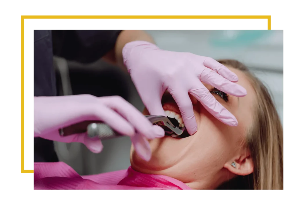 Natychmiastowa implantacja to procedura polegająca na wszczepieniu implantu zęba bezpośrednio po usunięciu zęba, podczas tej samej wizyty.