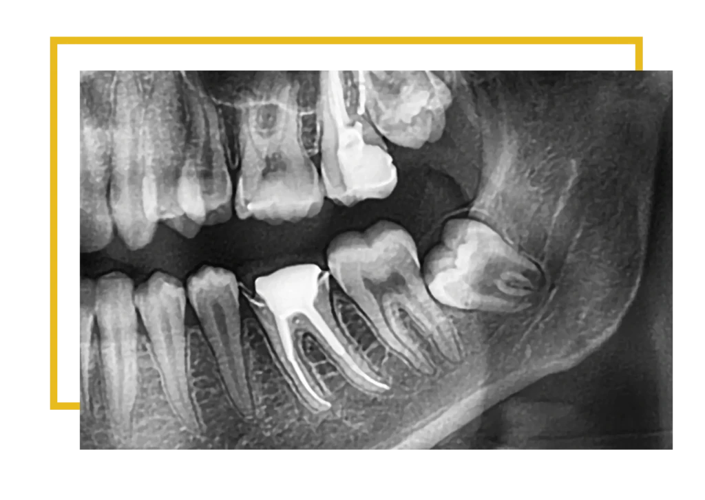 Ząb zatrzymany to taki, który nie wyrżnął się w pełni, przez co nie jest widoczny w jamie ustnej i pozostaje w kości szczęki lub żuchwy. Najczęściej dotyczy to właśnie trzecich trzonowców, czyli ósemek. W większości przypadków winne jest ich położenie — od lekkiego pochylenia ku zębom sąsiednim aż po całkowite ułożenie poziome.