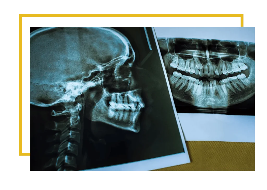 Ból po wszczepieniu implantu zęba jest zjawiskiem normalnym i najczęściej utrzymuje się od 2 do 5 dni.