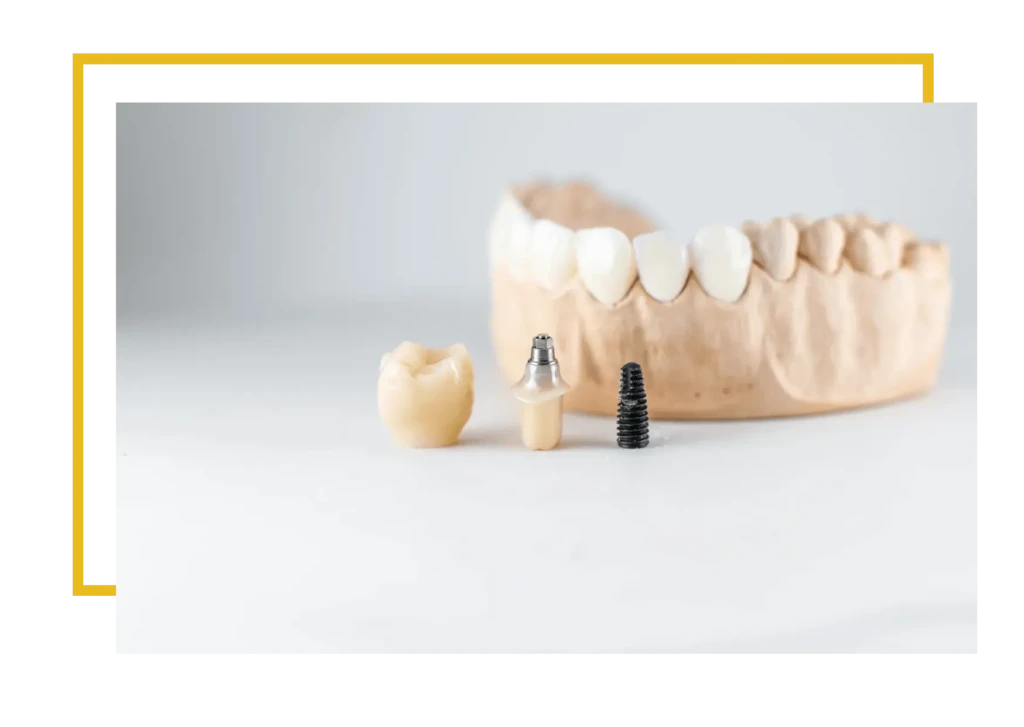 powikłania po wszczepieniu implantu. Wszczepienie implantu zębowego to procedura chirurgiczna polegająca na umieszczeniu tytanowej śruby w kości szczęki lub żuchwy, która zastępuje korzeń naturalnego zęba. Cały zabieg jest zawsze odpowiednio planowany na podstawie diagnostyki obrazowej w postaci tomografii CBCT oraz badania klinicznego.