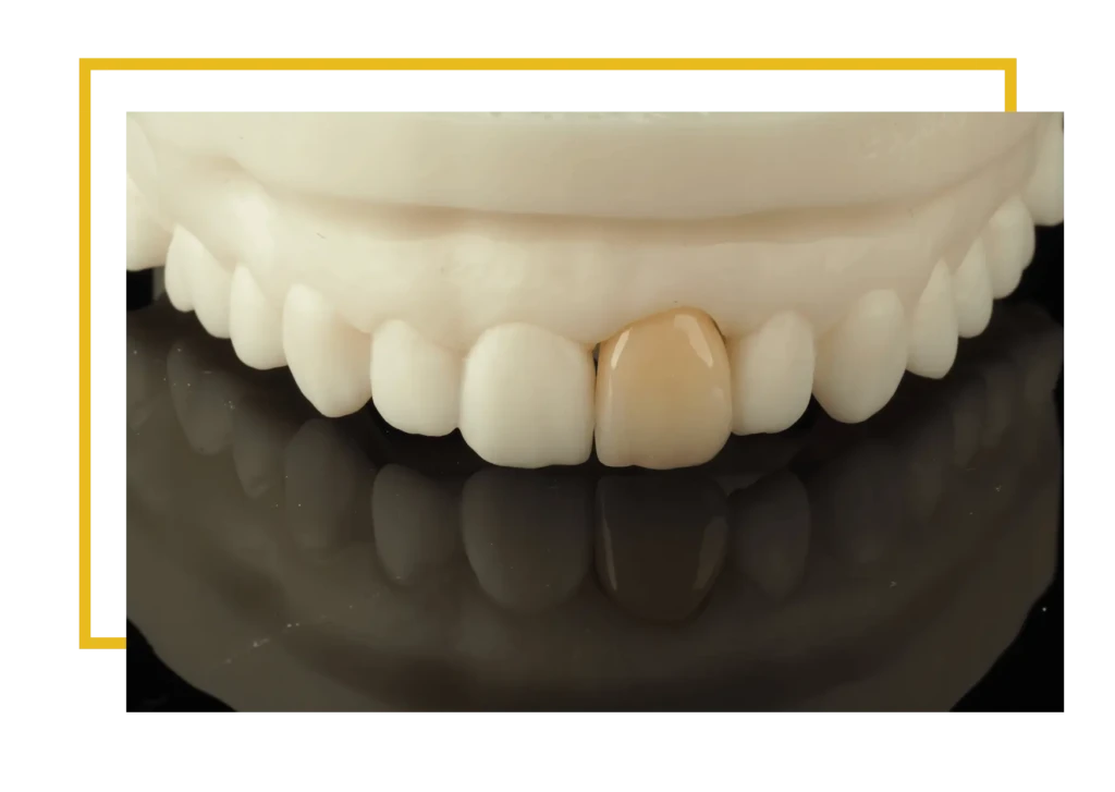 Korony cyrkonowe licowane porcelaną