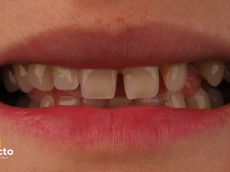 metamorfoza uśmiechu przed i po