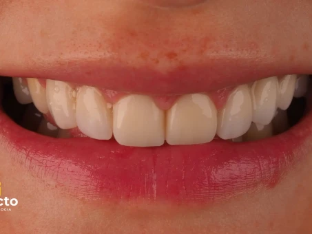 metamorfoza uśmiechu przed i po