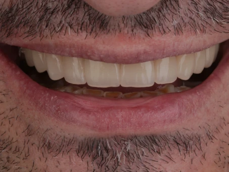 metamorfoza Exacto clinic dentysta poznań dentysta Jarocin