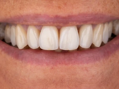 Metamorfoza Exacto Clinic Dentysta Jarocin Dentysta Poznań
