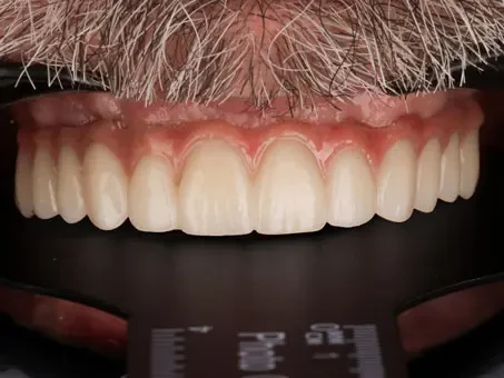 Uśmiech w jeden dzień All on 6 w Exacto Clinic Dentysta Jarocin Dentysta Poznań