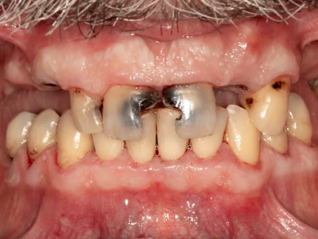 Uśmiech w jeden dzień All on 6 w Exacto Clinic Dentysta Jarocin Dentysta Poznań