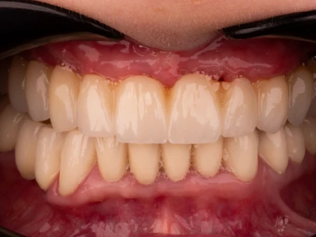 Przemiana uśmiechu Exacto clinic Dentysta Poznań Dentysta Jarocin